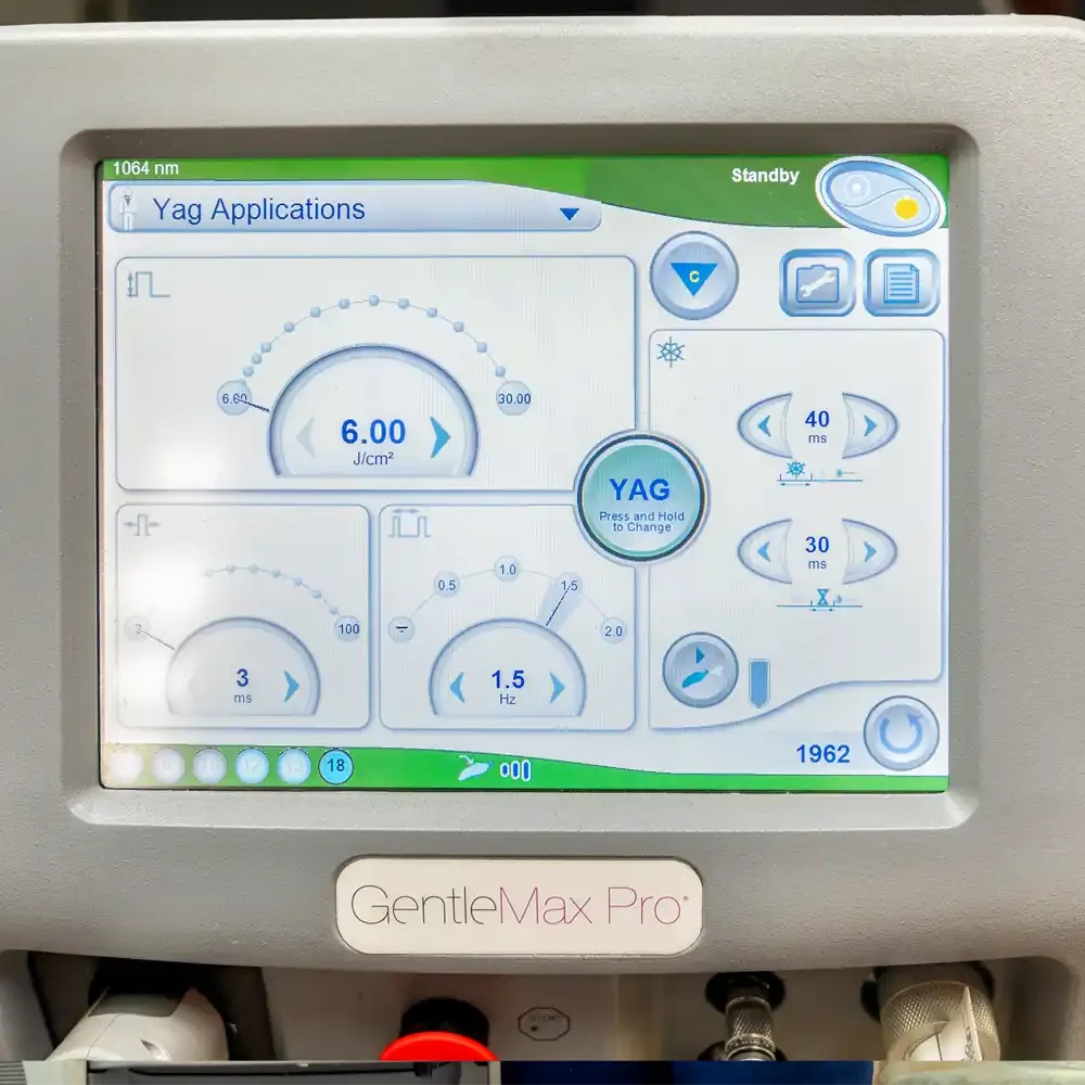 ND YAG laser hair removal